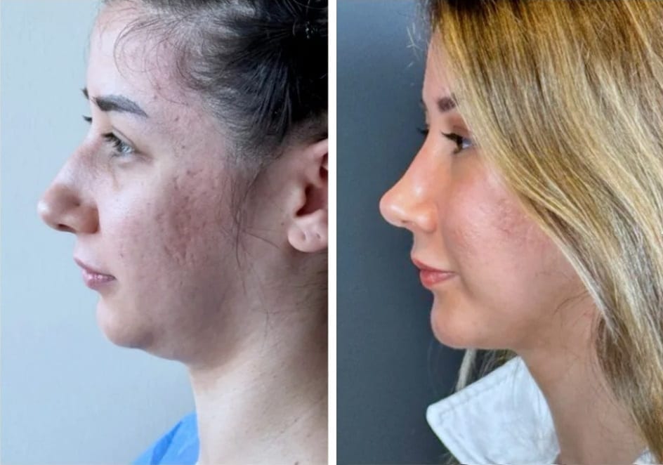Rinoplastia caso 8 — antes y después